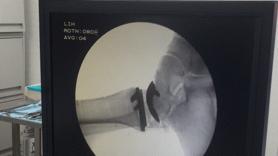 Интраоперационная проверка движений в суставе с помощью электронно-оптического перобразователя рентгеновских лучей.