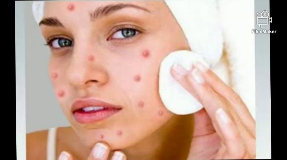    Как помочь ребенку с прыщами без насмешек