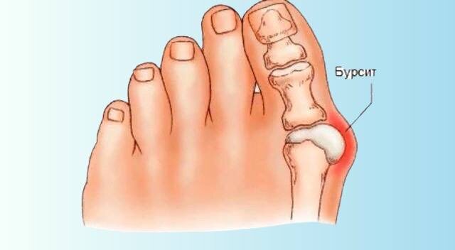 Почему растет косточка на большом пальце? Как вовремя распознать проблему и устранить ее?