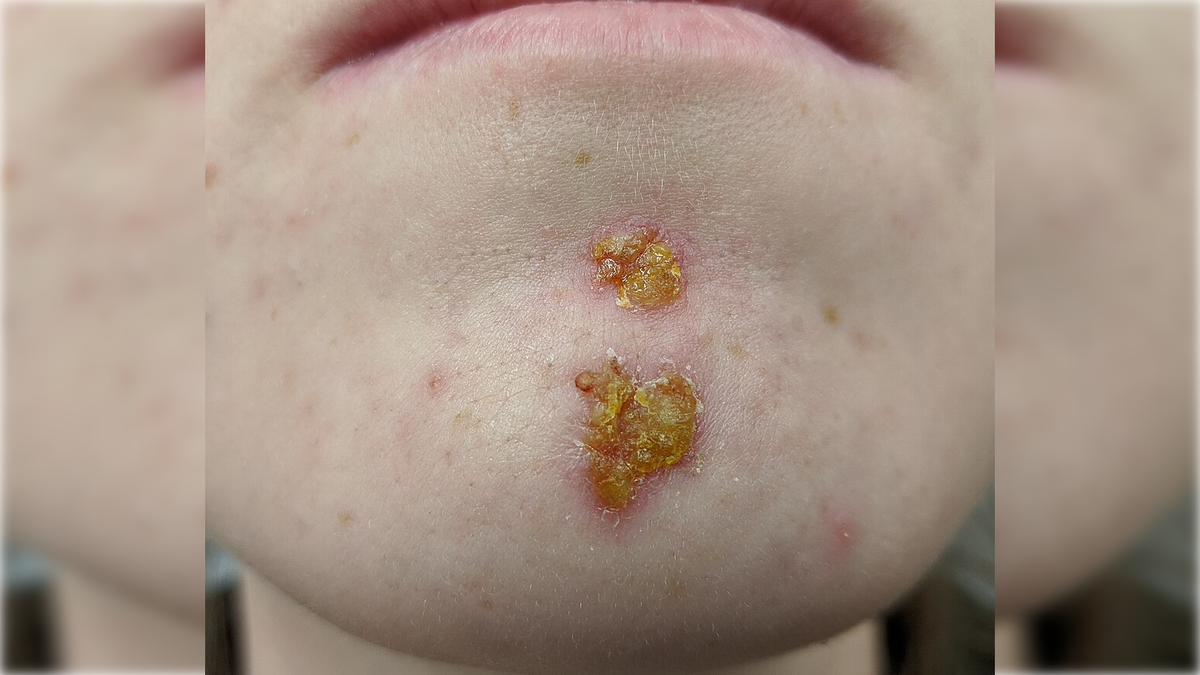 Фото: By James Heilman, MD/commons.wikimedia.org