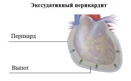 Экссудативный перикардит