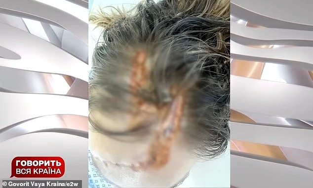 На фотографии из больницы видны глубокие раны на голове Марии, идущие от макушки к правому виску.