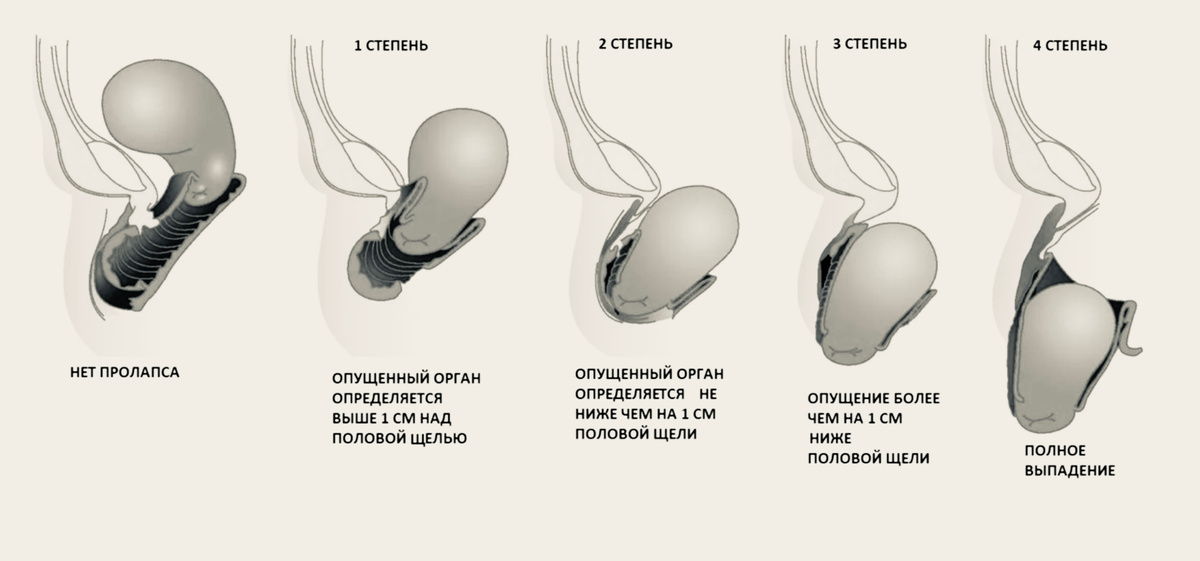 Половая жизнь вначале болезненна, потом невозможна, про остальные ощущения - можно себе представить, чтобы быть замотивированной их никогда не испытать.