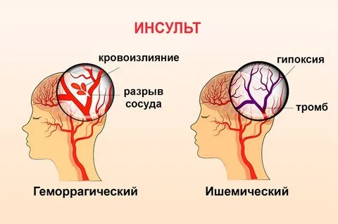 Полная инструкция: Что делать в первые 3 минуты при инсульте