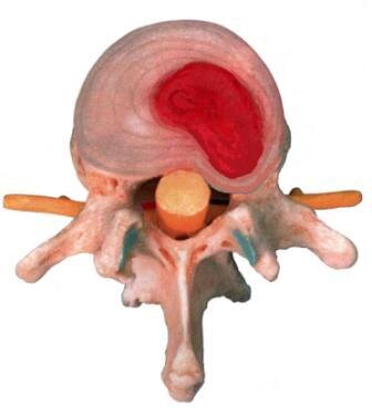 Грыжа диска - парамедиальная протрузия, без разрыва фиброзного кольца