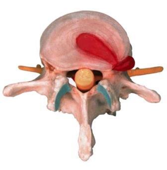Грыжа диска - боковая экструзия, с разрывом фиброзного кольца
