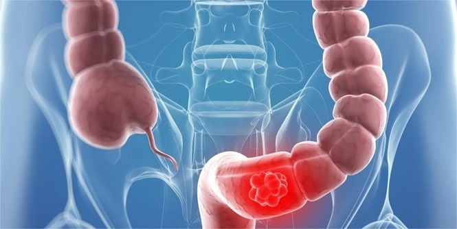 Полная инструкция: как распознать рак кишечника на ранней стадии
