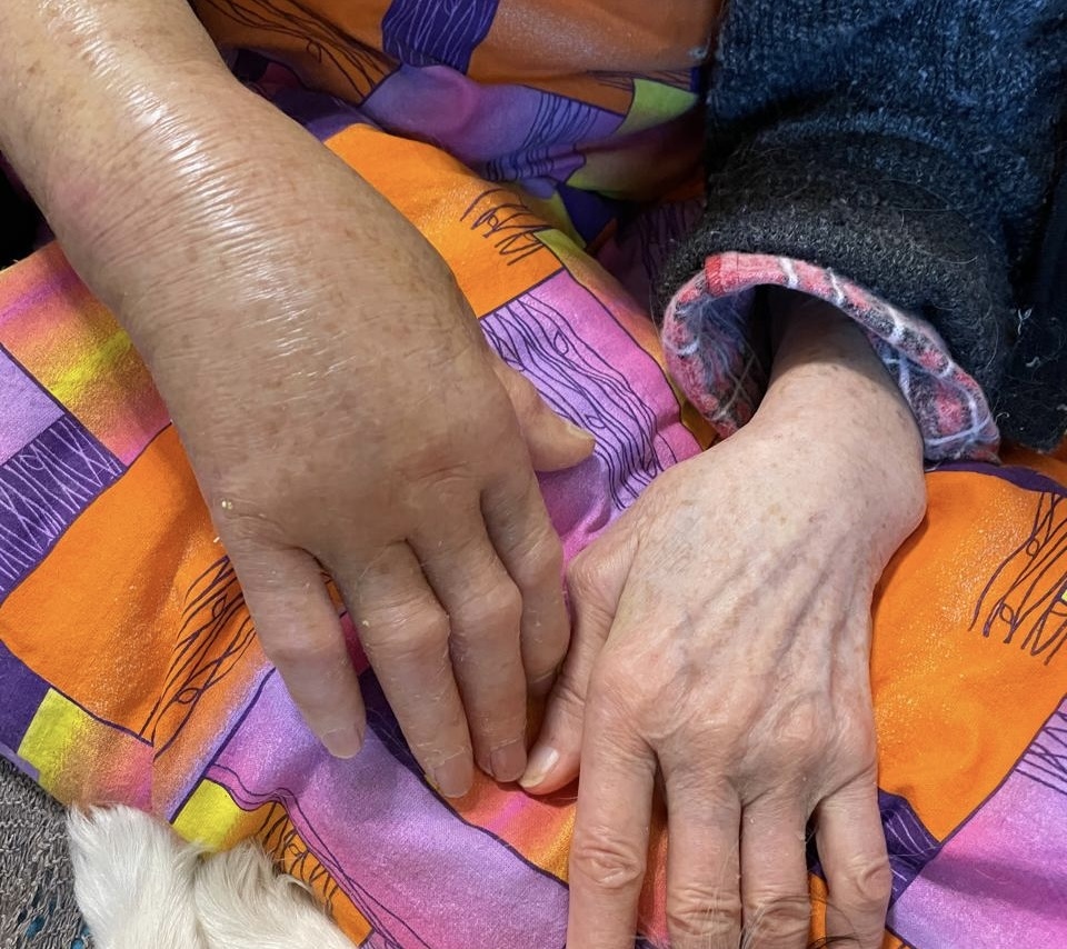 Так выглядела рука спустя месяц ношения гипса. Кости срослись, а рука болит и пухнет с каждым днем все сильнее. 