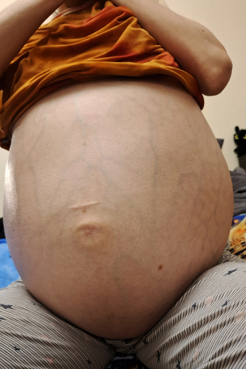 Напряженный асцит