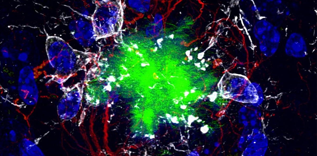 Амилоидные бляшки в ткани мозга пациента с болезнью Альцгеймера