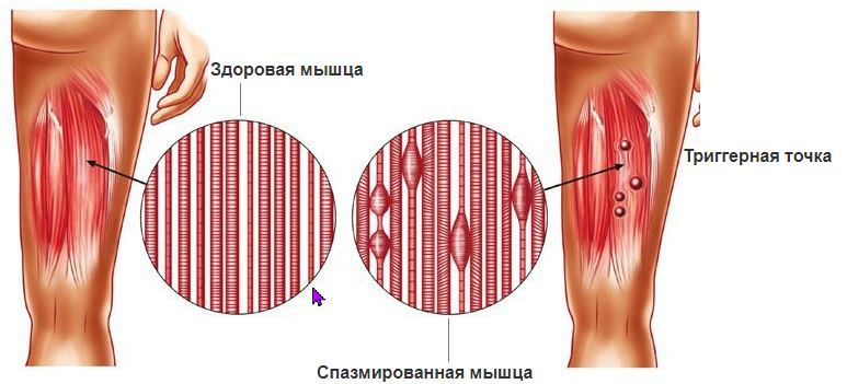 Мышечные «узелки»: правда о триггерных точках и как их обезвредить