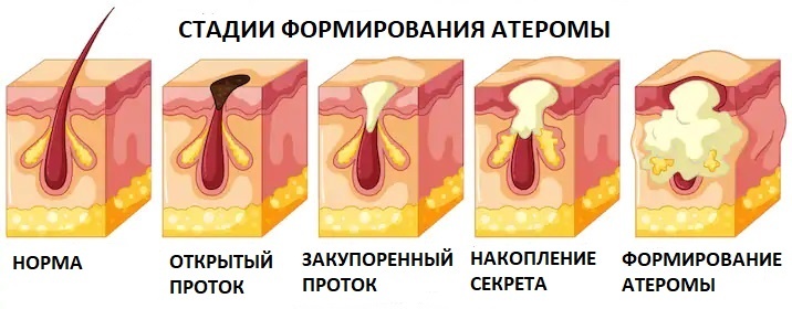 Формирование атеромы