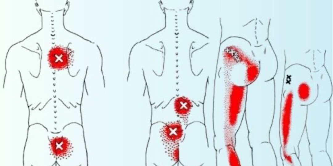 Боль в спине, скованность в шее и тянущие ощущения в ногах? Триггерные точки, которые могут облегчить ваше состояние