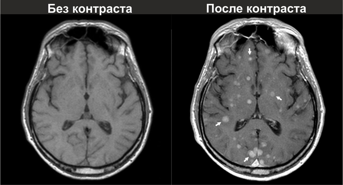 Сравнение до и после использования контрасного вещества.