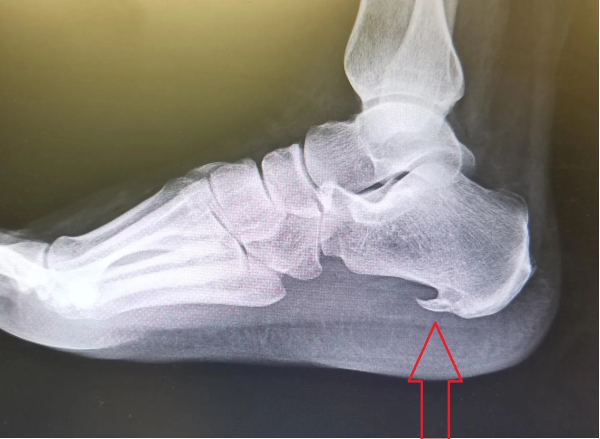 Костный нарост в районе соединения пятки и плантарного сухожилия. Именно он вызывает боль при ходьбе.