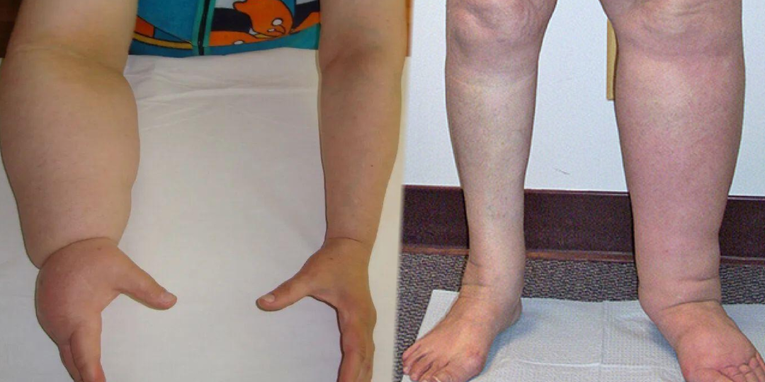 Полная инструкция: Как улучшить лимфоток после 40 лет и избежать отёков