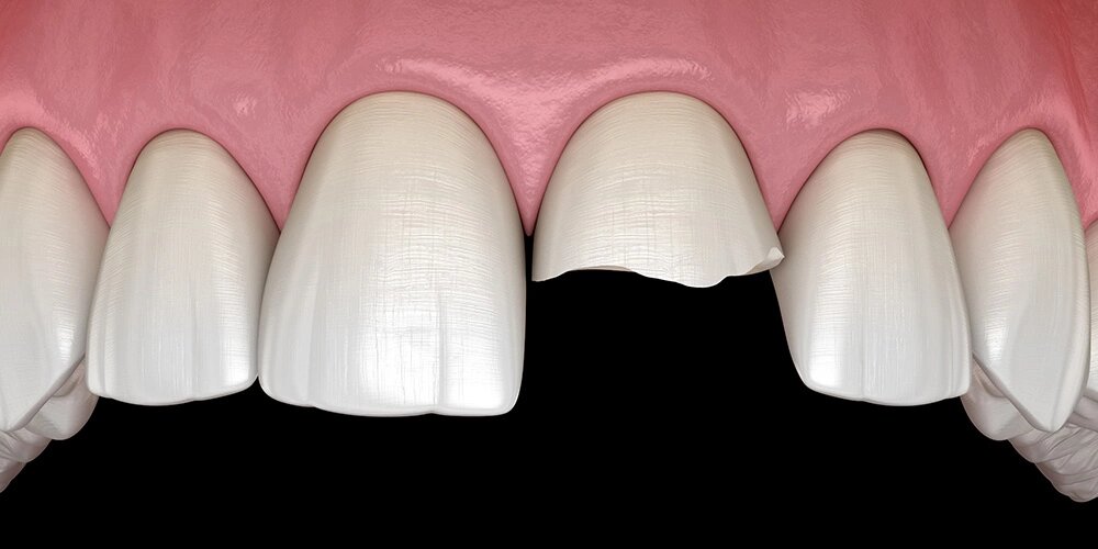 Сломан передний зуб