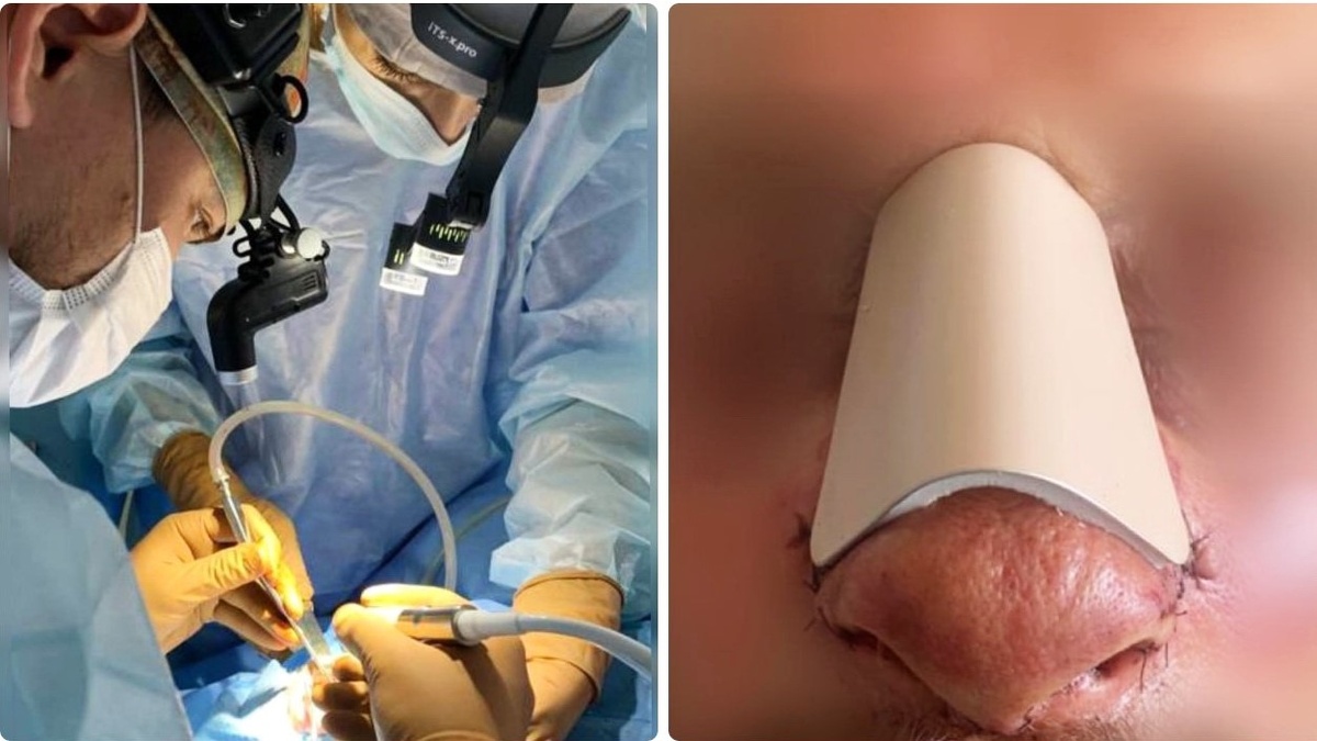    Югорчанину полностью пересобрали нос