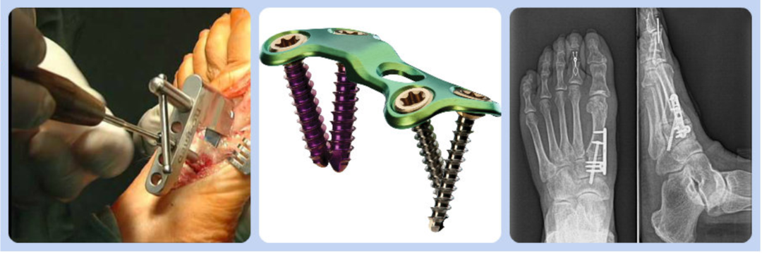 Плохое восстановление функций стопы после операции на удаление косточки