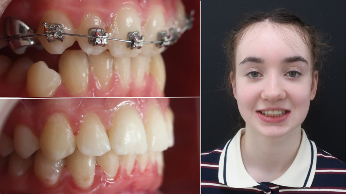 Путь к красивой улыбке длиною почти 3 года!