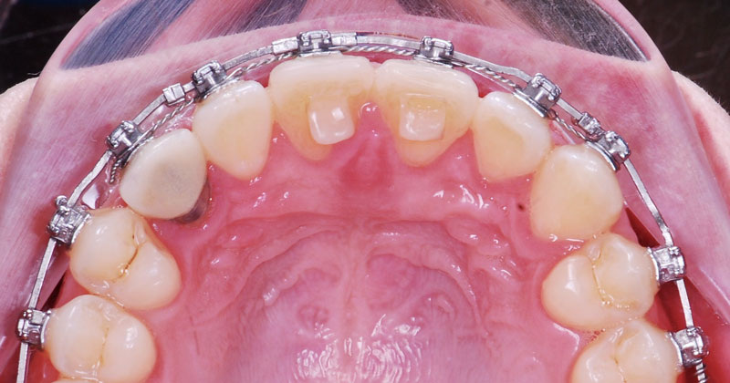 Накусочные разобщающие площадки