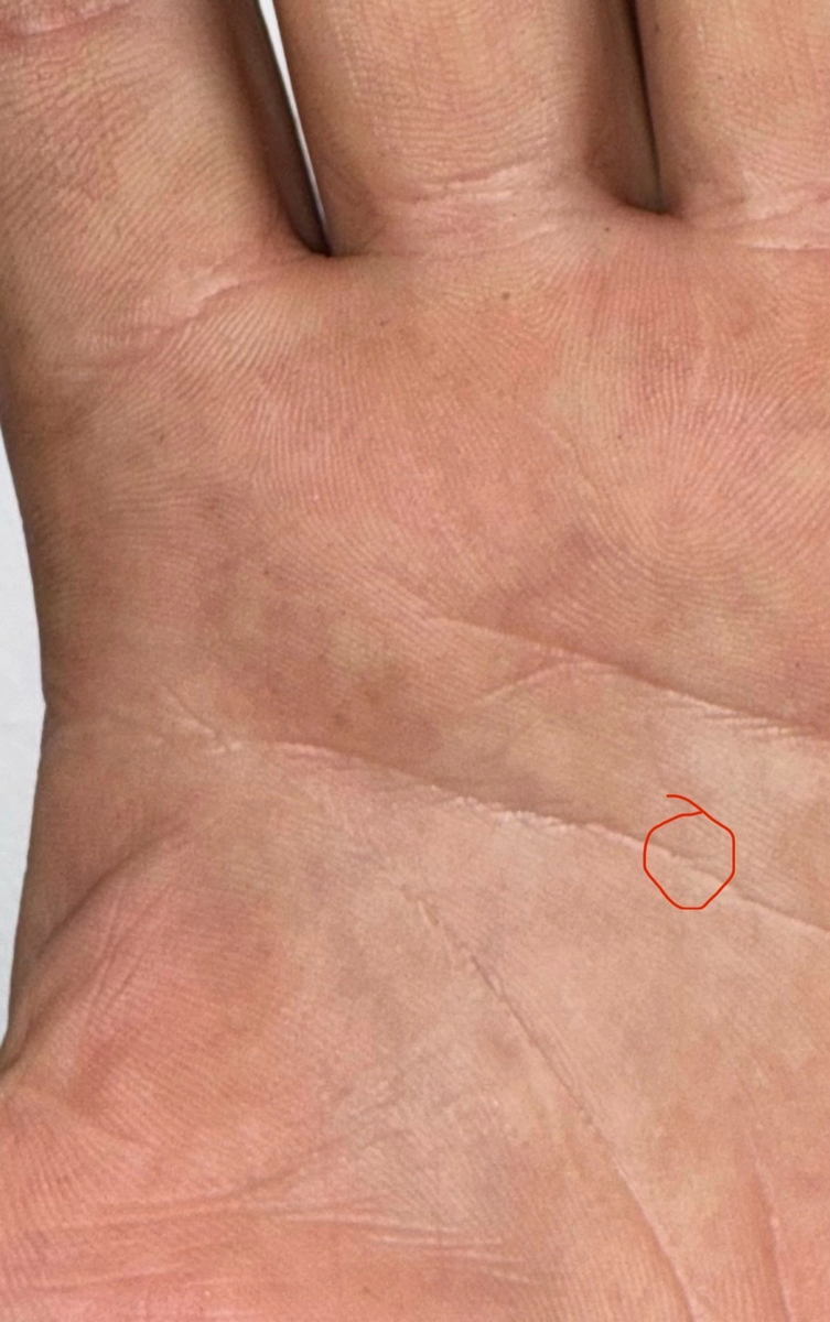 Небольшой разрыв на линии головы в 40 лет