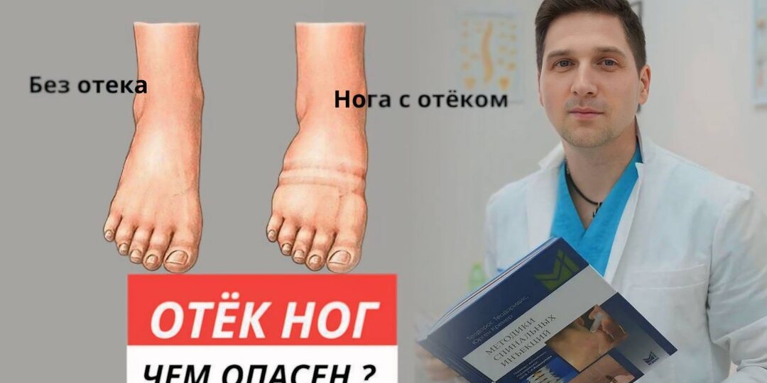Как победить отёки ног: два простых шага, которые изменят всё