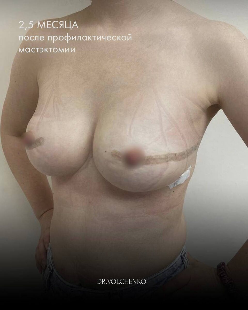 Пример восстановления спустя 2,5 месяца после профилактической мастэктомии