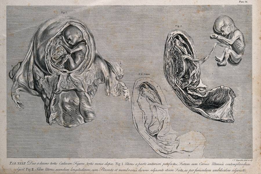 Плод в матке и сечение плаценты и матки с плодом, прикрепленным пуповиной. Гравюра
Фото: Jan van Rymsdyk / Wellcomeimages.com