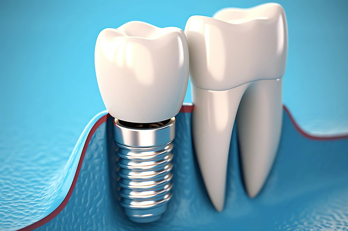 Зубной имплант