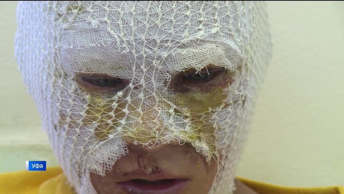    Восемь детей и банка с порохом: стали известны подробности ЧП, где дети обожгли лица в Башкортостане
