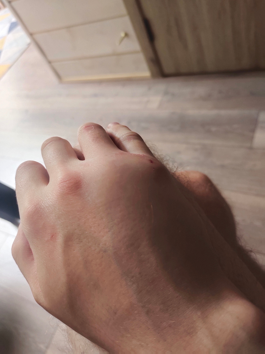 Моя опухшая лапа