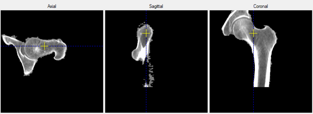 КТ-исследование минеральной плотности бедренной кости. Источник: Наталия Сивакова
