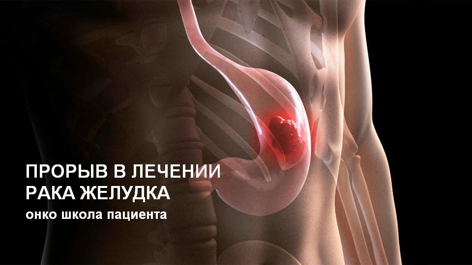 Лечение рака желудка становится эффективнее