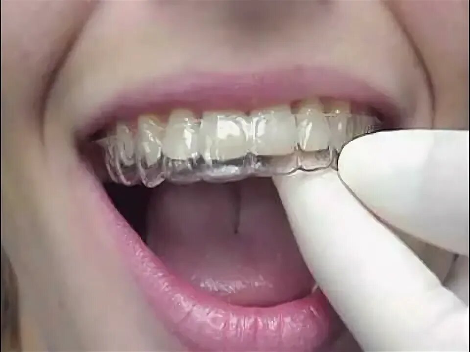 Нарушение в технологии изготовления и установки ретейнеров могут смещать зубы