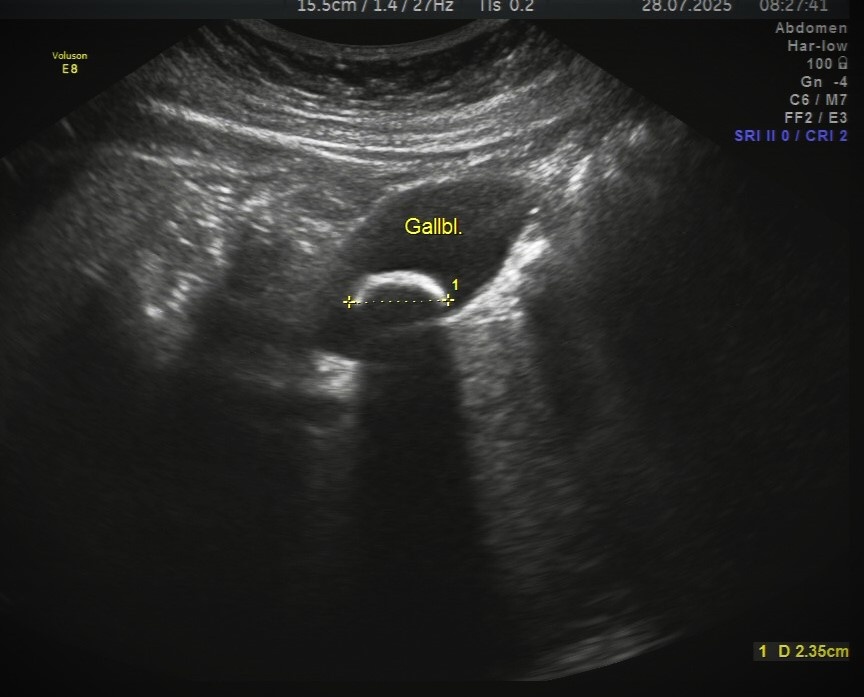 Вот так на УЗи выглядит камень в желчном пузыре (камень выглядит как яркая белая дуга, обозначен желтой пунктирной линией, позади него определяется тень, темная структура вокруг и есть желчный пузырь). До определенного момента желчекаменная болезнь может никак себя не проявлять, чтобы увидеть камень нужно делать УЗИ до появления острых симптомов, особенно в случаях наследственной предрасположенности 