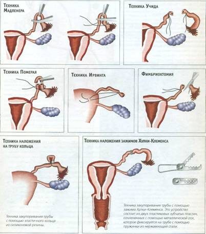 Из Яндекс картинок... Перевязка труб. 