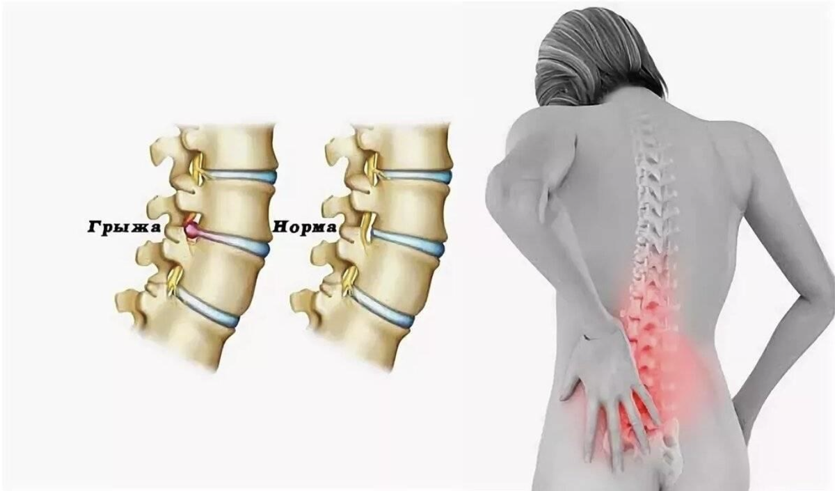 Наиболее часто встречаются грыжи межпозвонковых дисков пояснично-крестцового отдела позвоночника (150 случаев на 100 000 населения в год), 