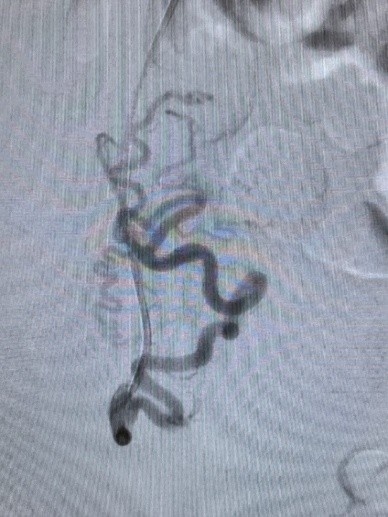 определяется анатомия артерий, которые питают миоматозный узел
