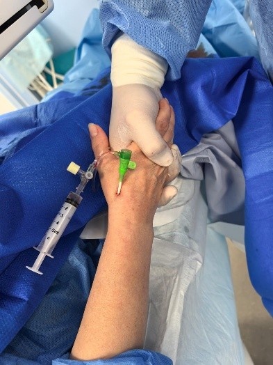 В Юсуповской больнице процедура эмболизации маточных артерий проводится под местной анестезией через прокол на предплечье или в паху. 