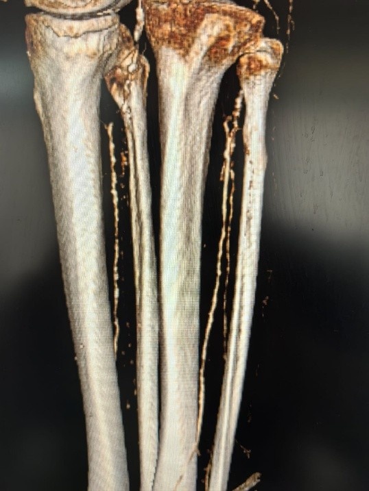 мультиспиральлная компьютерная томография артерий с контрастированием