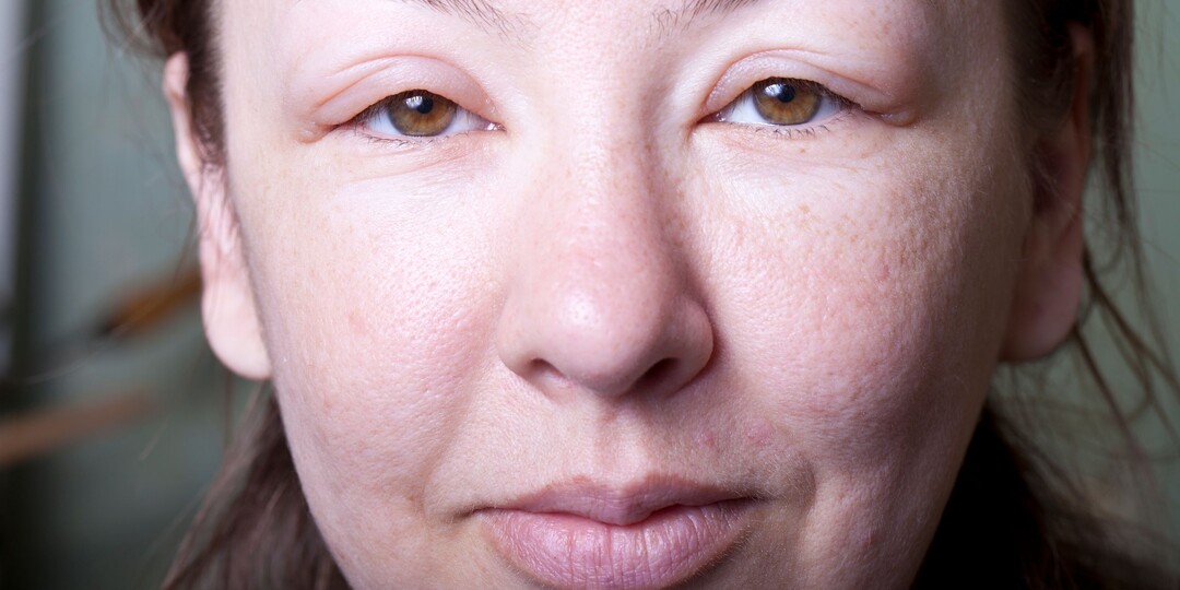 Почему опухают веки — не всегда аллергия