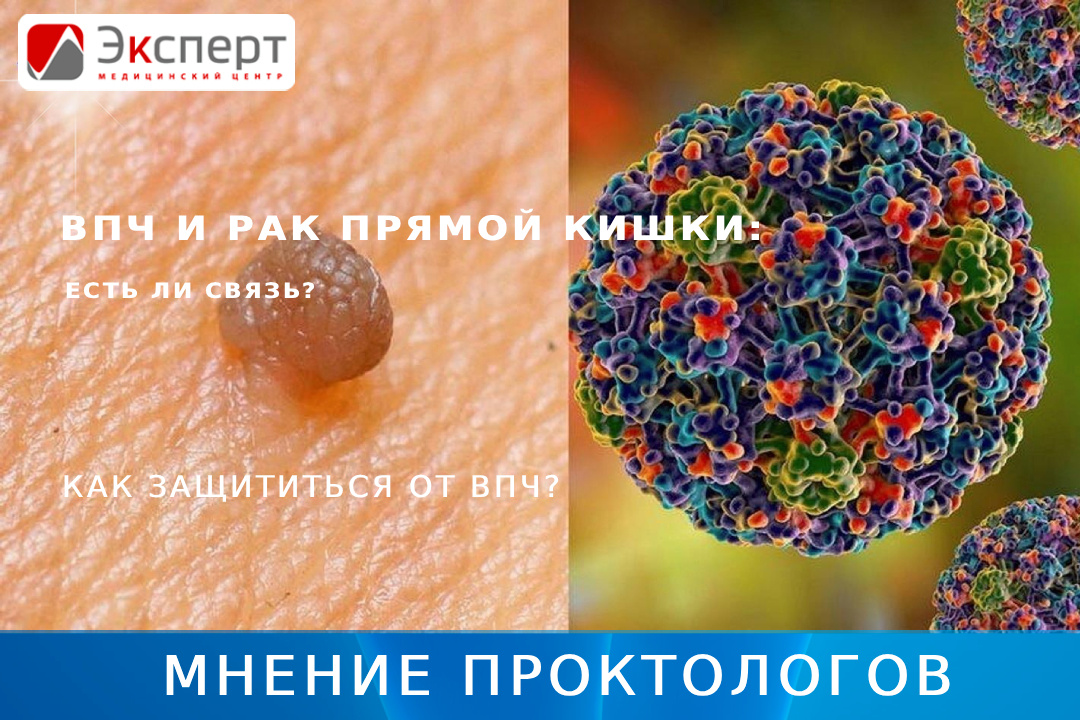 ВПЧ и рак прямой кишки