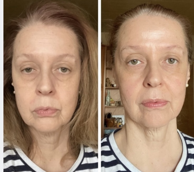 Это мои до и после. Буккальный массаж