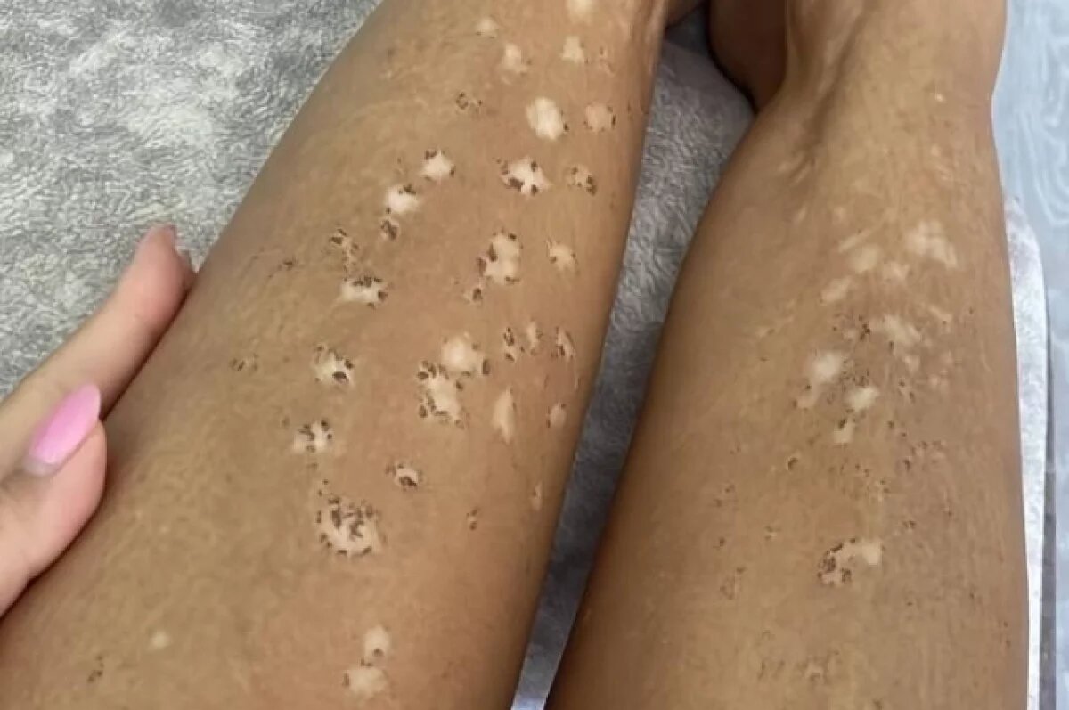    В Новосибирске модель получила ожоги после лазерной эпиляции