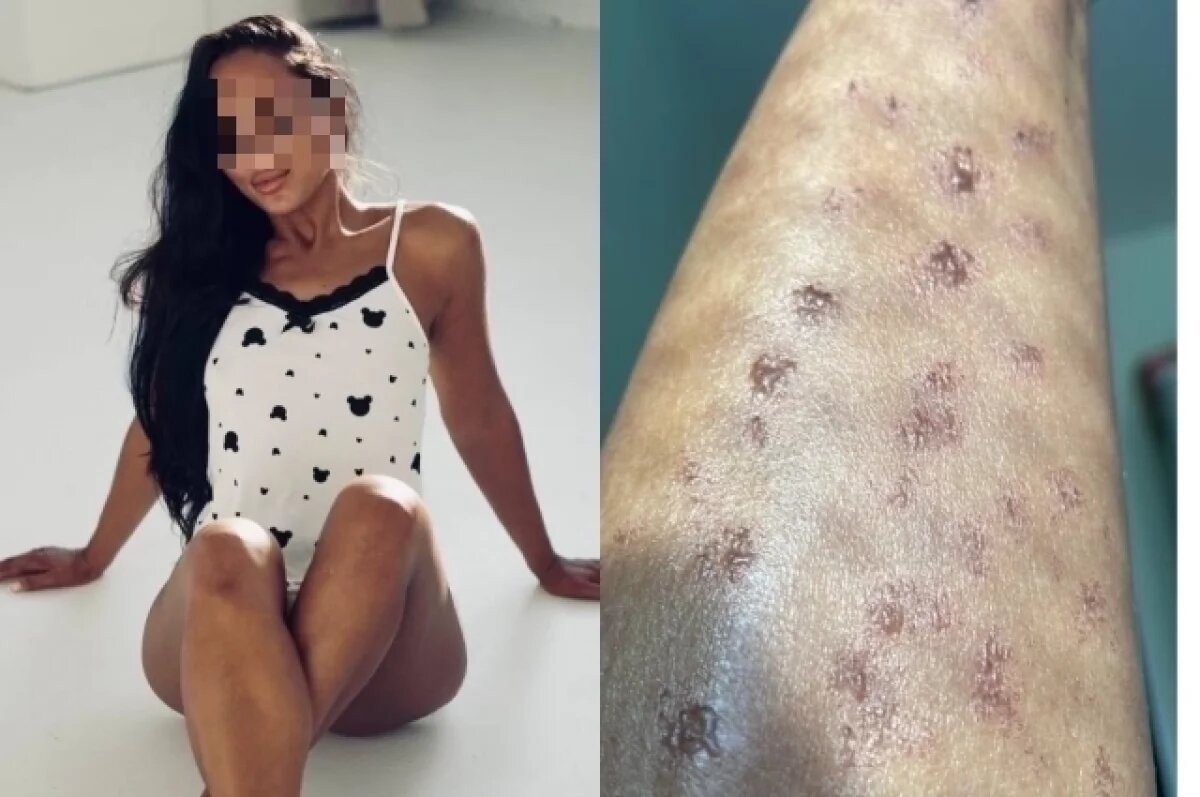    Кристина работает моделью, но теперь этот заработок перешел на второй план. Ведь девушка вынуждена заниматься лечением травмированных на процедуре ног.