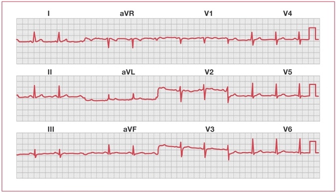 Пример нормальной ЭКГ. Источник изображения: https://www.ncbi.nlm.nih.gov/books/NBK2214/.