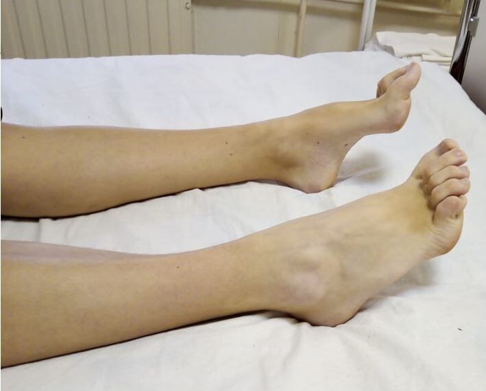 Характерный вариант деформации стопы при хронической полинейропатии