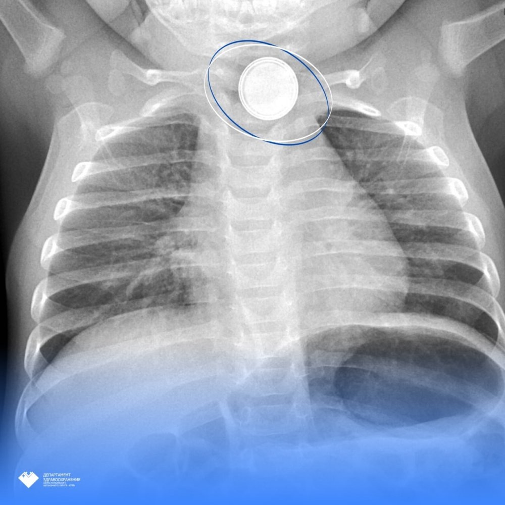    Сургутские врачи спасли малыша, проглотившего батарейку