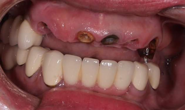 После снятия протезов